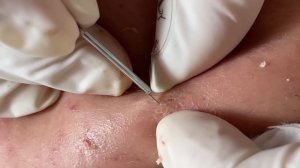 Выдавливание черных точек: ASMR-эффект гарантирован!