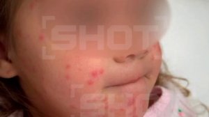 Трёхлетняя девочка заразилась кожной инфекцией после укуса комара и купания в бассейне на Бали.