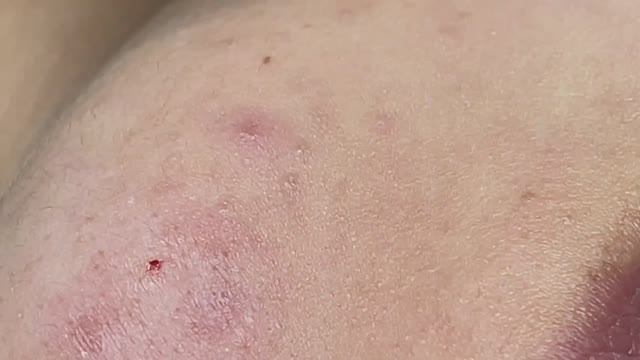 Техника безопасного выдавливания созревших угрей Linh #113