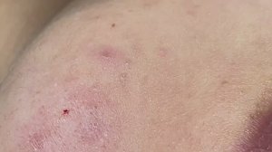 Техника безопасного выдавливания созревших угрей Linh #113