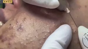 НЕВОЗМОЖНО ОТОРВАТЬСЯ! Удаление прыщей и черных точек — гипнотическое видео #887629