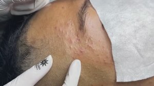 Механическое очищение кожи от угревой сыпи Linh #610