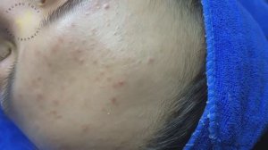 Черные точки и прыщи: комплексный подход к очищению кожи ТТ SDS (#144)