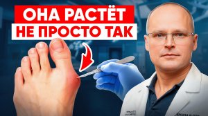 3 причины из-за чего она начинает расти после 35 лет! Косточка на ноге / косточка на стопе