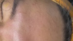 Профессиональная чистка от черных точек и акне ТТ SDS (#147)