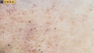 Черные точки и прыщи: комплексный подход к очищению кожи 2152