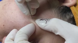 ШОК! Под кожей скрывались десятки белых точек. Смотрим чистку.  - SDS#276