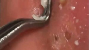 Чистка лица от угрей и акне. Выдавливание прыщей. Удаление черных точек и комедонов