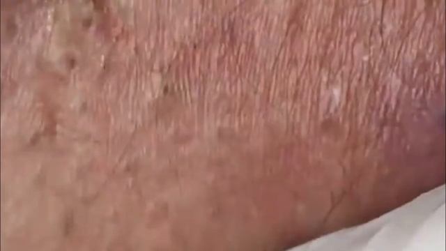 #25 Чистка лица от угрей и акне. Выдавливание прыщей. Удаление черных точек и комедонов