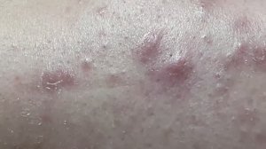 Чистка лица от угревой сыпи у косметолога