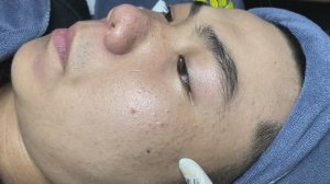 Профессиональное удаление комедонов Mimi 035