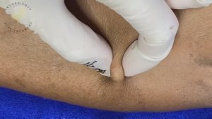 Гипнотическое видео: удаление черных точек и прыщей подряд ТТ SDS (#142)