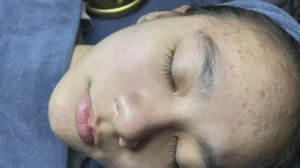 Эффективное лечение акне MiMi 0001