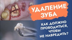 Как удалять зубы без осложнений?