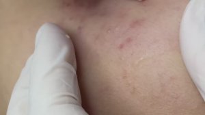 Чистим кожу от закрытых комедонов и черных точек - ТТ#64