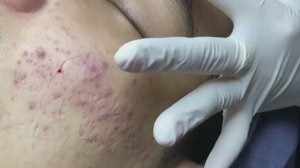 Процедуры для лечения акне в спа-центре