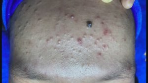 Лечение закрытых комедонов на лбу - SDS#281