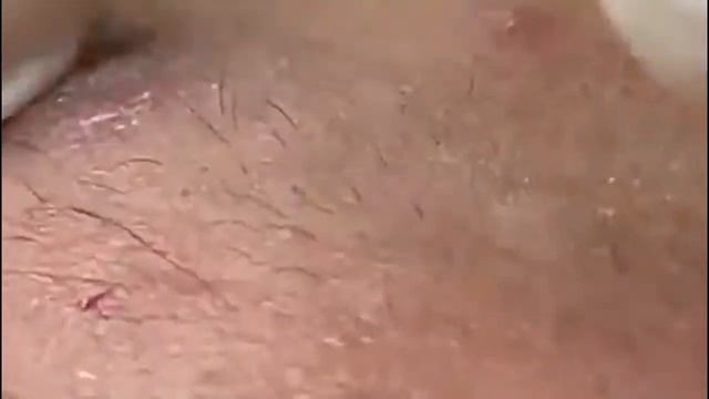 #20 Чистка лица от угрей и акне. Выдавливание прыщей. Удаление черных точек и комедонов