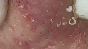 НЕ МОГ ОТОРВАТЬСЯ! Процесс чистки лица от всех несовершенств #887561