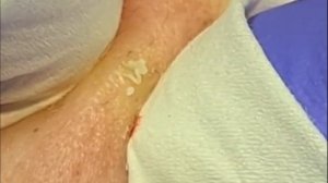 Чистка лица от угрей и акне. Выдавливание прыщей. Удаление черных точек и комедонов