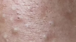 УБИРАЕМ ВСЁ! Чистка лица от черных точек и огромных прыщей 😱 2150