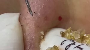 Жесткая чистка лица черные точки прыщи #887626