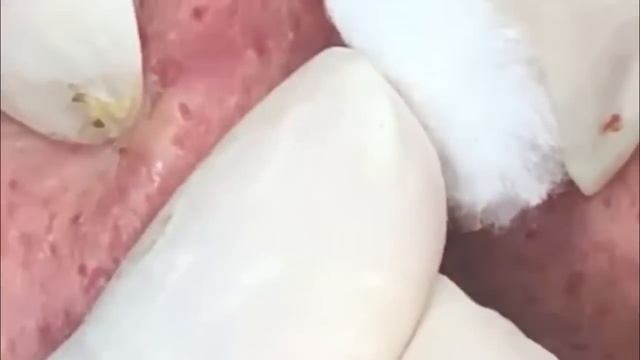 #24 Чистка лица от угрей и акне. Выдавливание прыщей. Удаление черных точек и комедонов