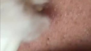 Чистка лица от угрей и акне. Выдавливание прыщей. Удаление черных точек и комедонов