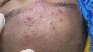 Лечение подкожных прыщей на лице. - SDS#282