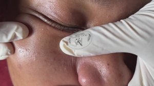 Механическая чистка лица от угрей.