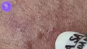 САМАЯ ЖЕСТКАЯ ЧИСТКА! Море черных точек и прыщей за 78 минут 😱 #887628