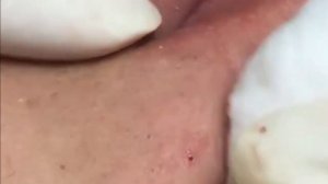 Чистка лица от угрей и акне. Выдавливание прыщей. Удаление черных точек и комедонов