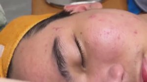 Профессиональное удаление белых точек (милиумов) иглой Hari # 011