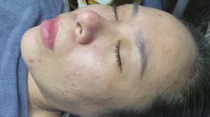 Удаление черных и белых точек Mimi 036