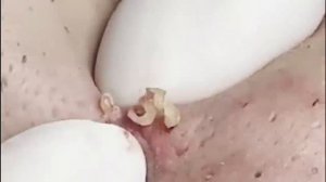 Чистка лица от угрей и акне. Выдавливание прыщей. Удаление черных точек и комедонов