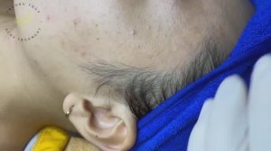 Удаление черных точек и прыщей: полный процесс чистки ТТ SDS (#140)