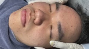 Чистка лица парню от черных точек MiMi