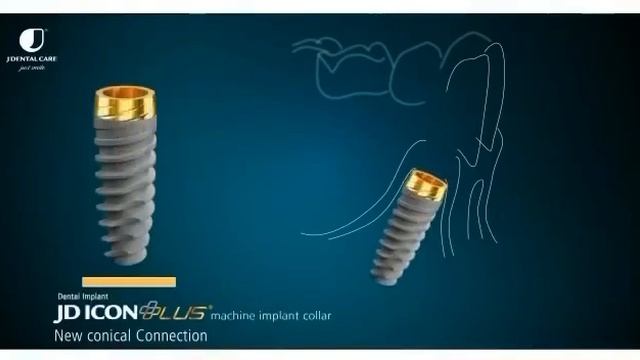 Виды имплантатов из Италии JDENTAL
