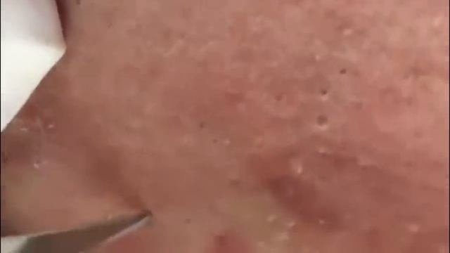 #19 Чистка лица от угрей и акне. Выдавливание прыщей. Удаление черных точек и комедонов