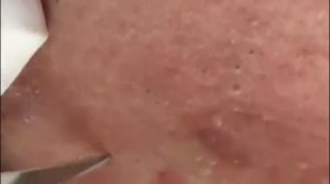 #19 Чистка лица от угрей и акне. Выдавливание прыщей. Удаление черных точек и комедонов