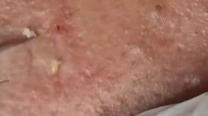 Чистка лица от угрей и акне. Выдавливание прыщей. Удаление черных точек и комедонов