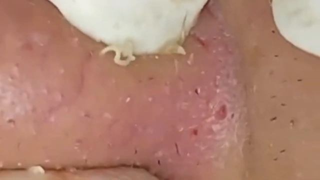 #13 Чистка лица от угрей и акне. Выдавливание прыщей. Удаление черных точек и комедонов