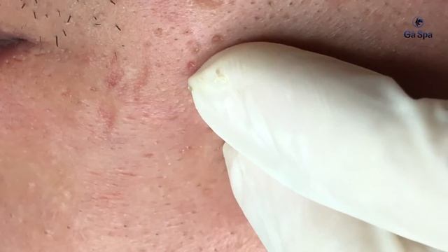 ВАУ! Черные точки вылетают от малейшего давления… GA