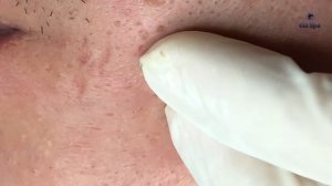 ВАУ! Черные точки вылетают от малейшего давления... GA