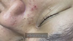 Удаление крупных прыщей: выводим глубокие воспаления #𝟗𝟎741