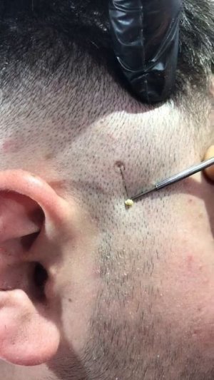 Чистка лица от угрей и акне. Выдавливание прыщей. Удаление черных точек и комедонов