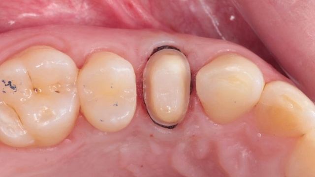 Секреты эстетической стоматологии: Примерка коронки от До до После