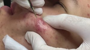 ПРОЩАЙ, АКНЕ! Лечение угревой сыпи