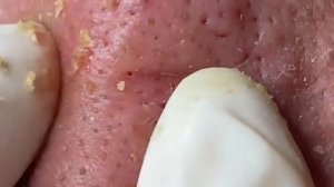 003 • Relax Spa • АСМР • Acne collection