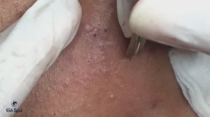 Чистка лица: удаление всех скрытых подкожных образований